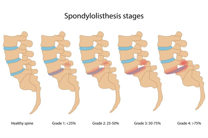 Spinal cord vertebrae lumbar vertebral located segments injury thoracic scoliosis sacral classification nerve